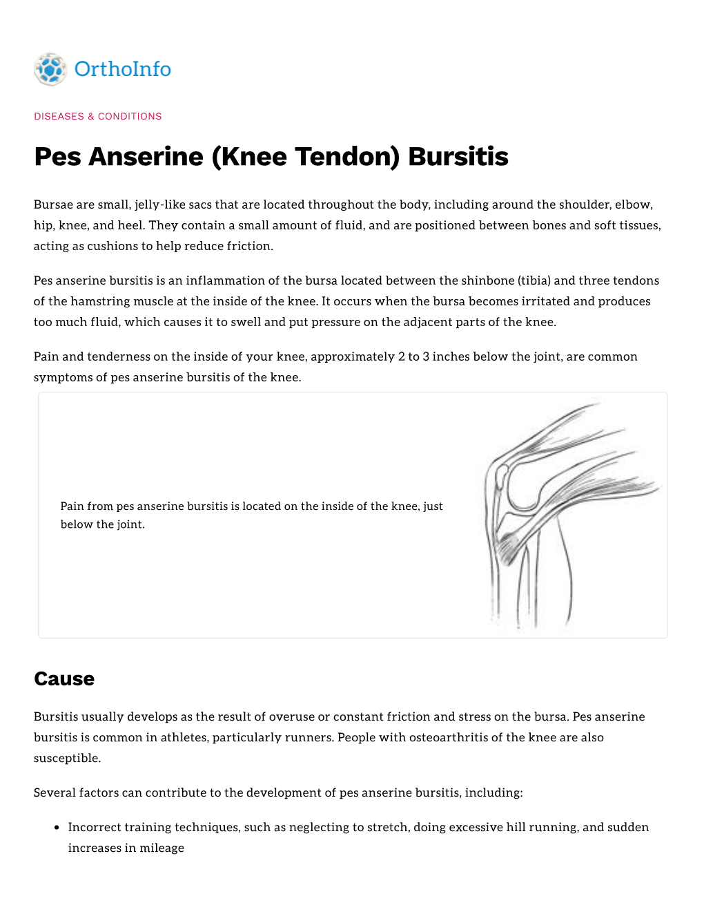 Pes Anserine Knee Tendon Bursitis Docslib