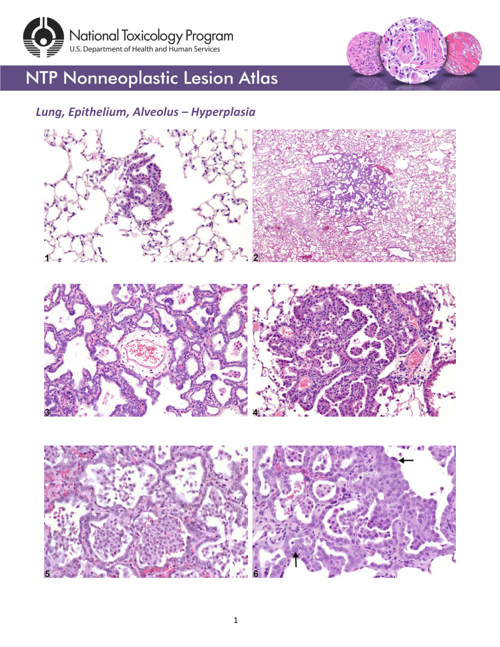 Lung, Epithelium, Alveolus – Hyperplasia