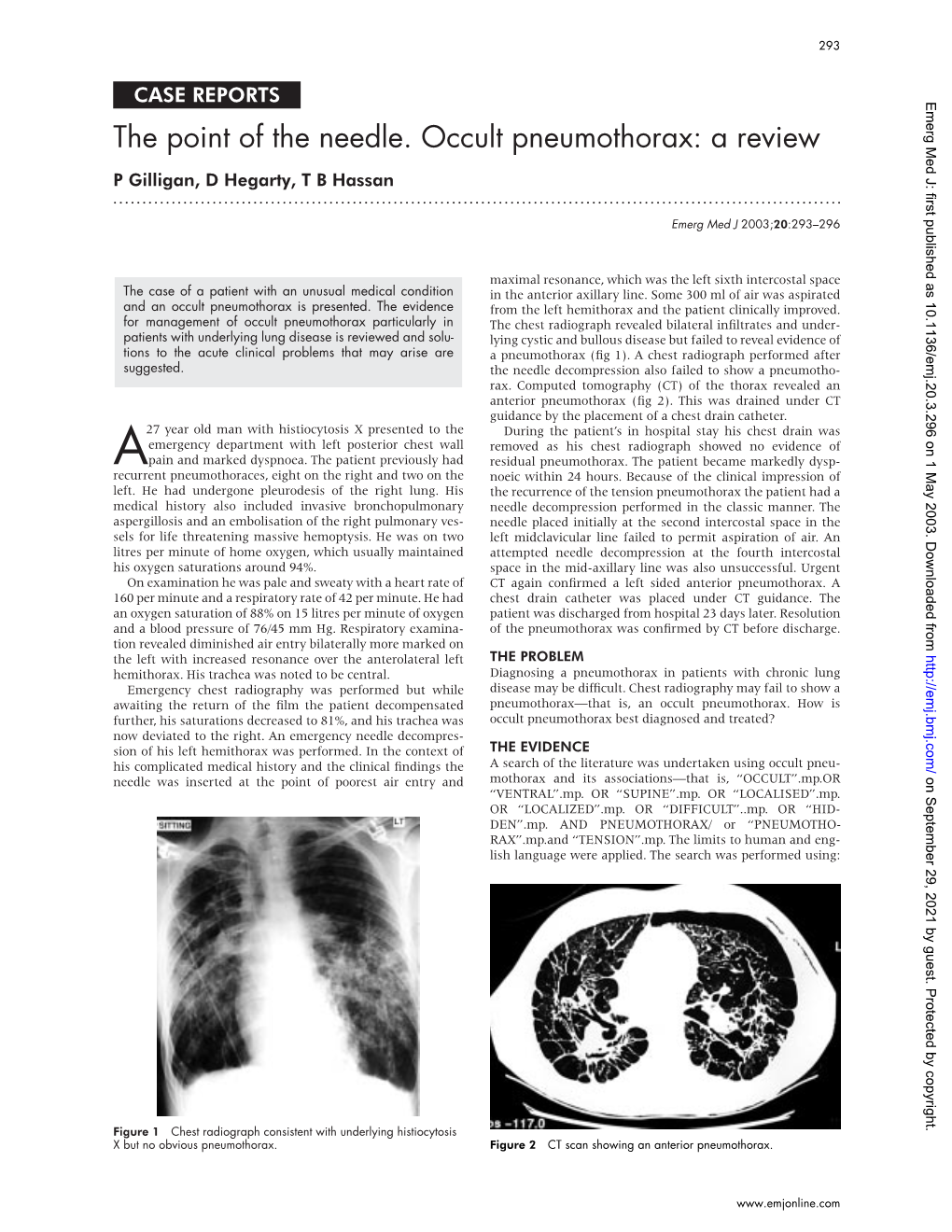 The Point of the Needle. Occult Pneumothorax: a Review P Gilligan, D Hegarty, T B Hassan