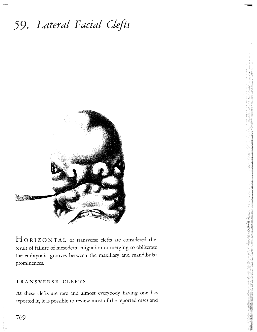 59. Lateral Facial Clefts