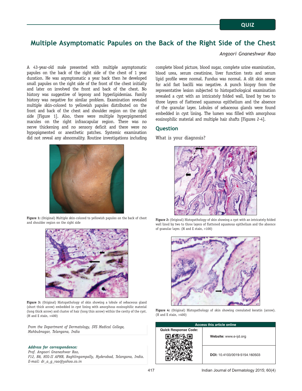 Multiple Asymptomatic Papules on the Back of the Right Side of the Chest Angoori Gnaneshwar Rao