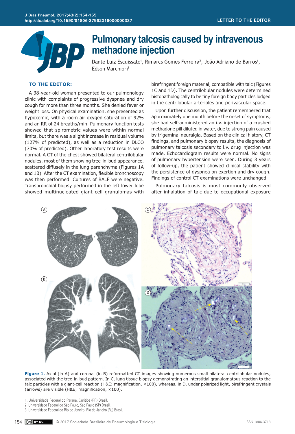 Pulmonary Talcosis Caused by Intravenous Methadone Injection Dante Luiz Escuissato1, Rimarcs Gomes Ferreira2, João Adriano De Barros1, Edson Marchiori3