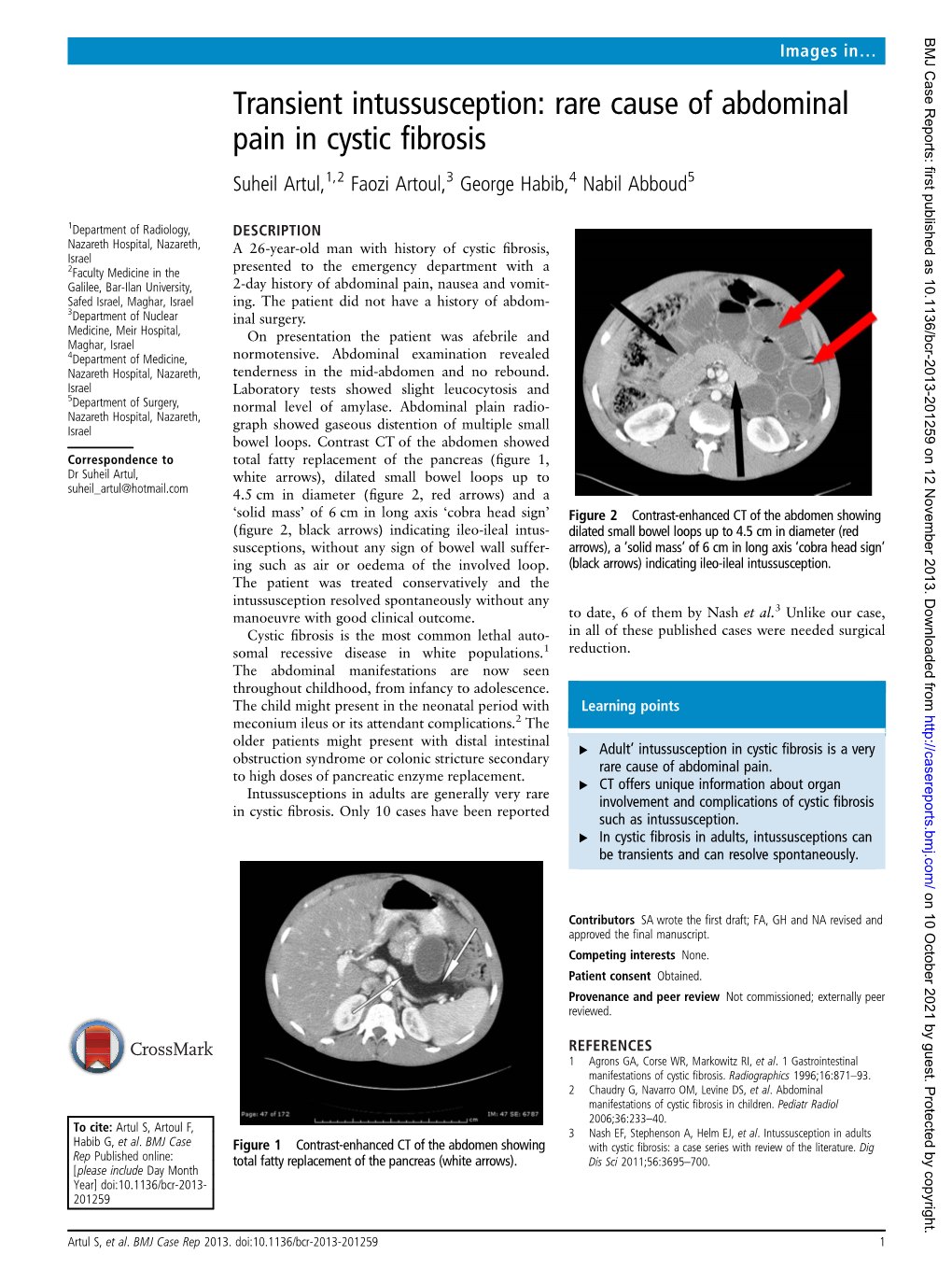 Rare Cause of Abdominal Pain in Cystic Fibrosis