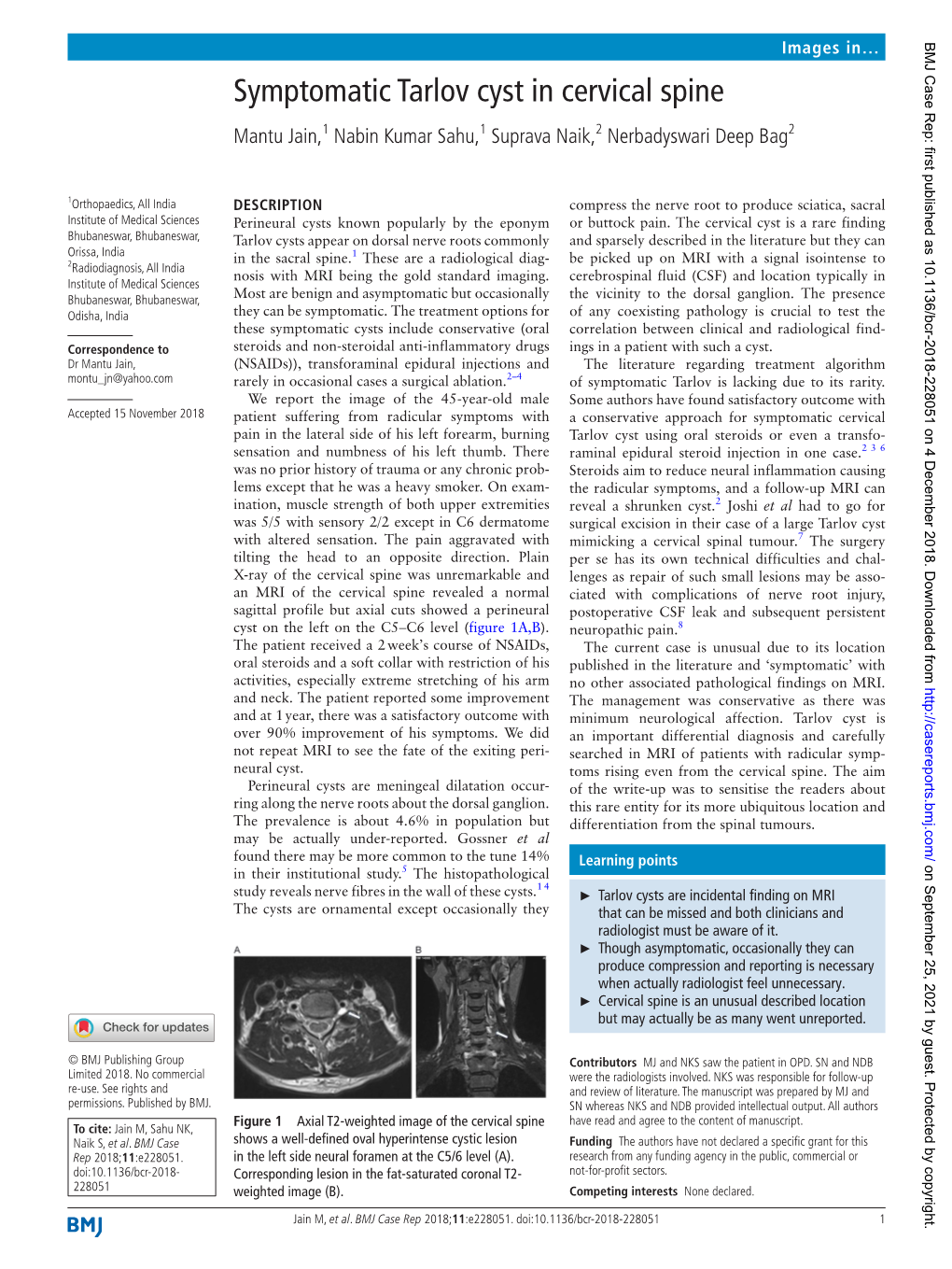 Symptomatic Tarlov Cyst in Cervical Spine Mantu Jain,1 Nabin Kumar Sahu,1 Suprava Naik,2 Nerbadyswari Deep Bag2