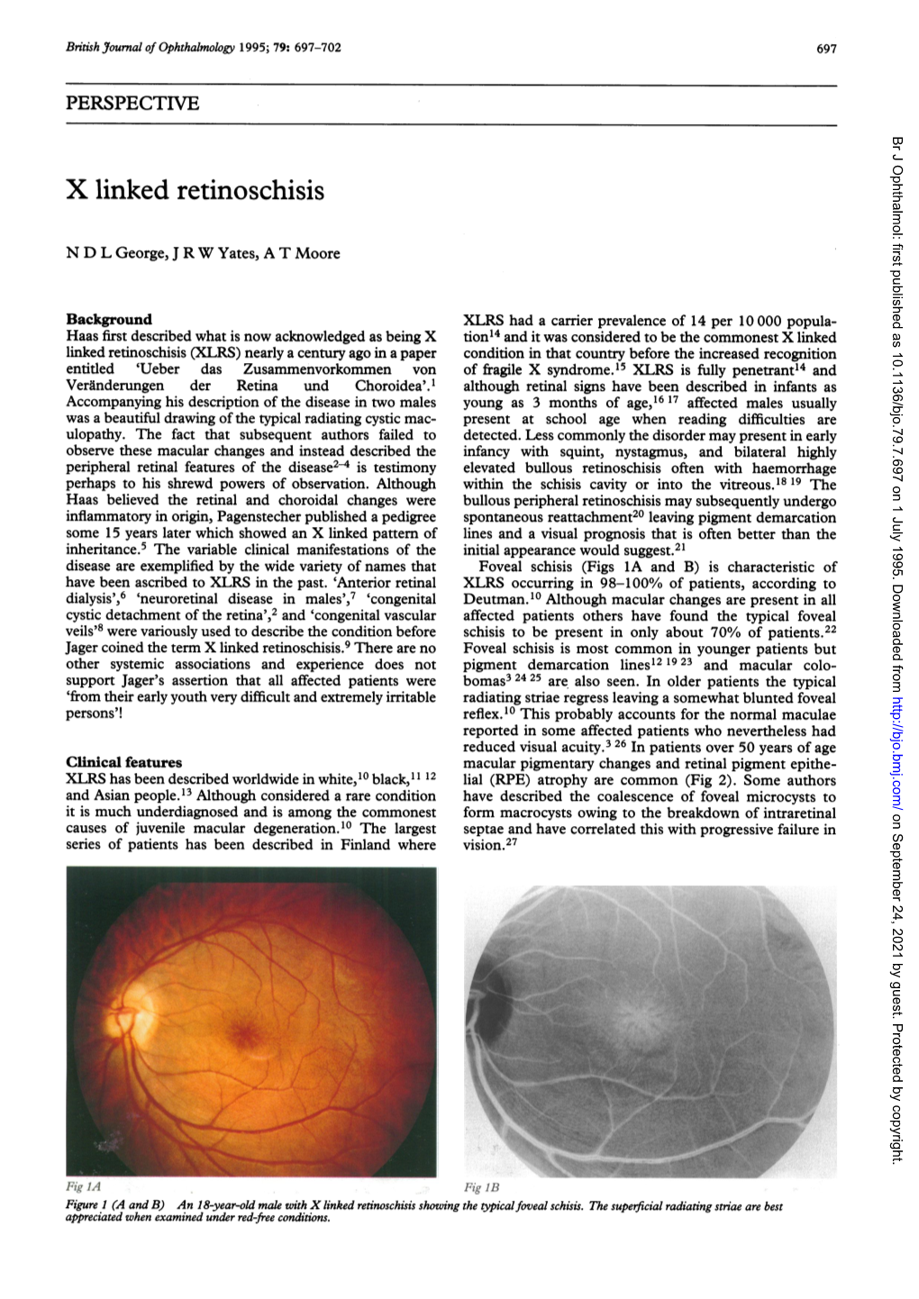 X Linked Retinoschisis