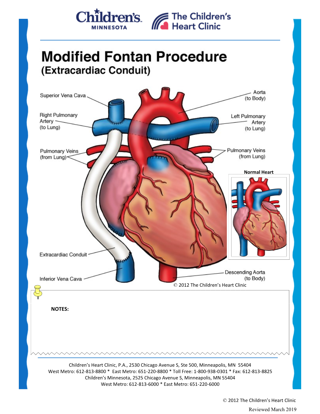 Modified Fontan Procedure: Extracardiac Conduit