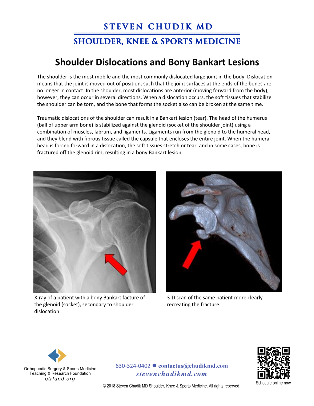 Bony Bankart Lesions and Shoulder Dislocations