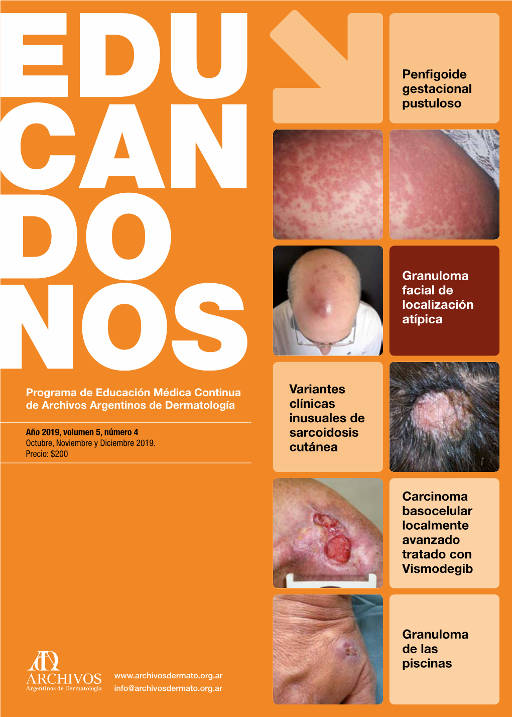 Granuloma De Las Piscinas Carcinoma Basocelular Localmente Avanzado