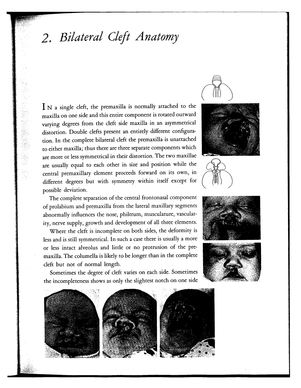 2. Bilateral Cleft Anatomy 19