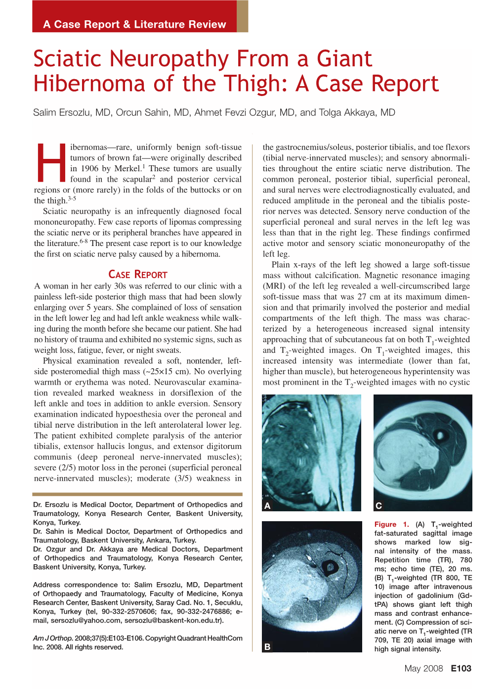 Sciatic Neuropathy from a Giant Hibernoma of the Thigh: a Case Report