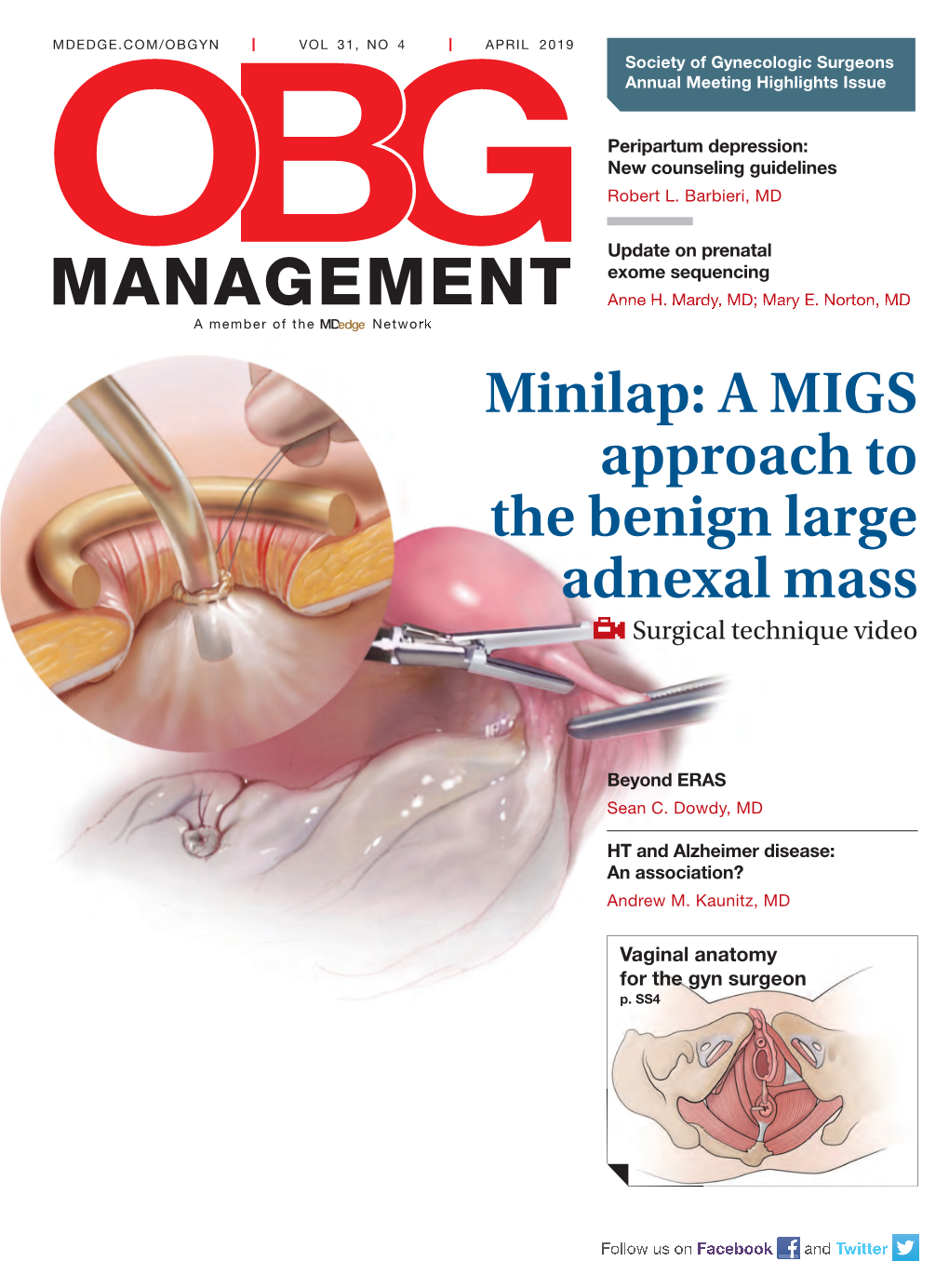 Minilap: a MIGS Approach to the Benign Large Adnexal Mass Surgical Technique Video