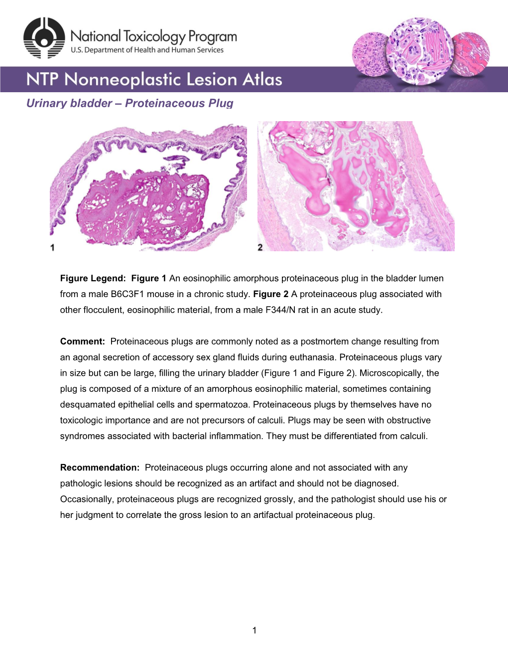 Urinary Bladder – Proteinaceous Plug