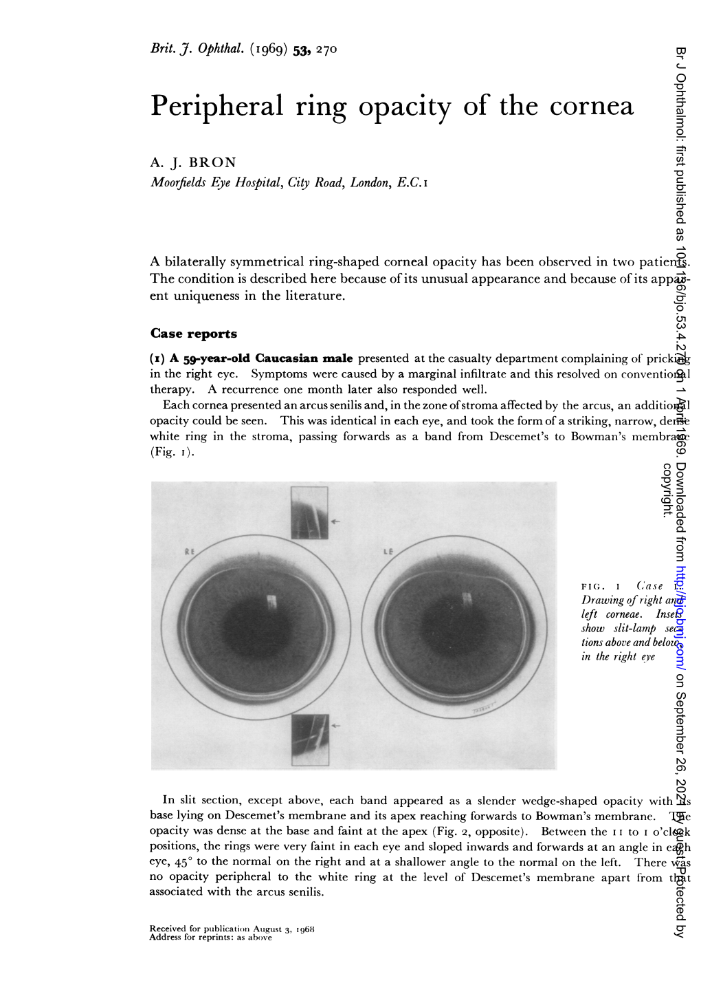 Peripheral Ring Opacity of the Cornea