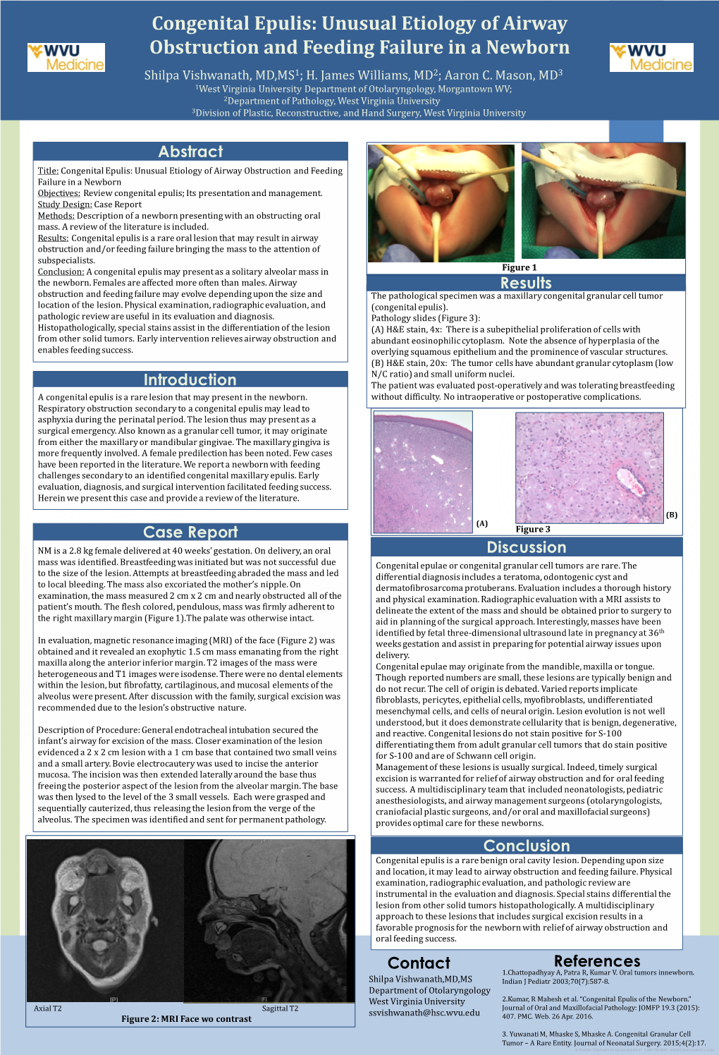 Congenital Epulis: Unusual Etiology of Airway Obstruction and Feeding Failure in a Newborn Shilpa Vishwanath, MD,MS1; H