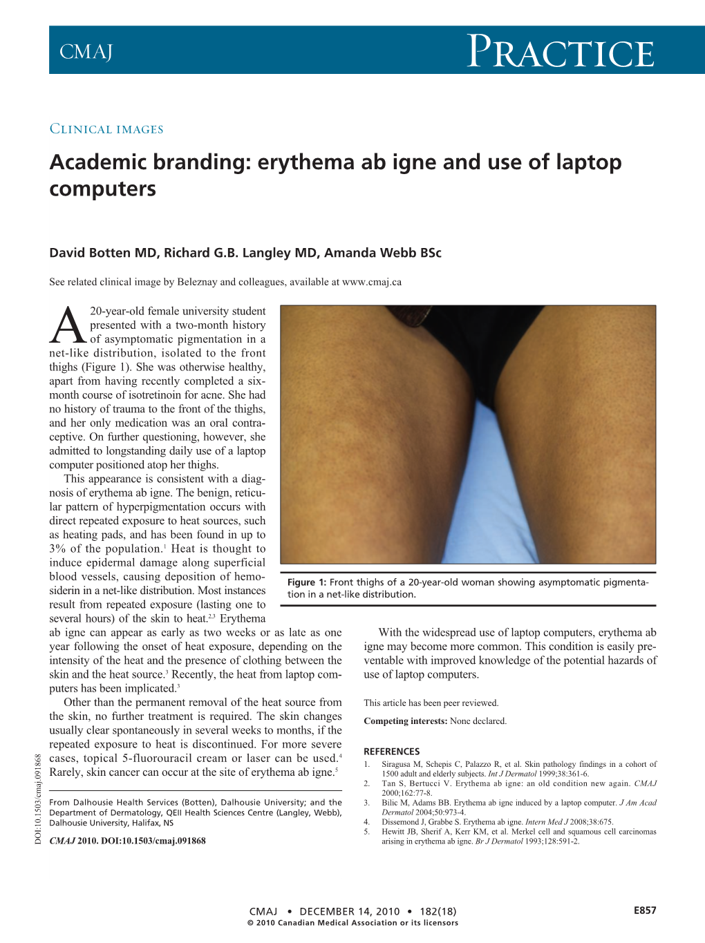 Erythema Ab Igne and Use of Laptop Computers