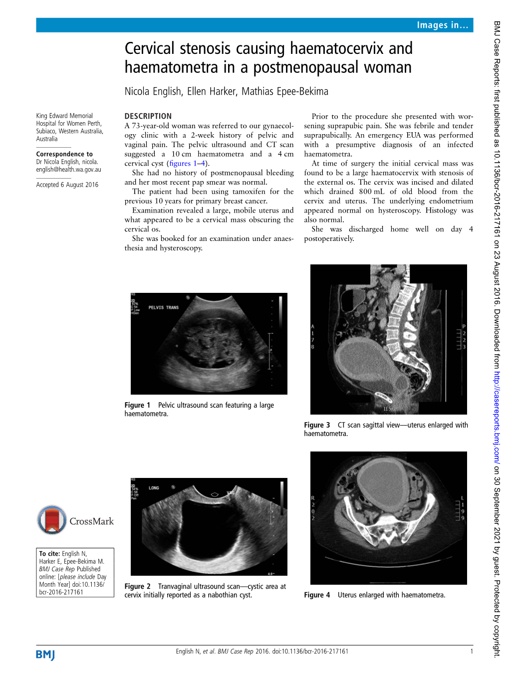 Cervical Stenosis Causing Haematocervix and Haematometra in a Postmenopausal Woman Nicola English, Ellen Harker, Mathias Epee-Bekima