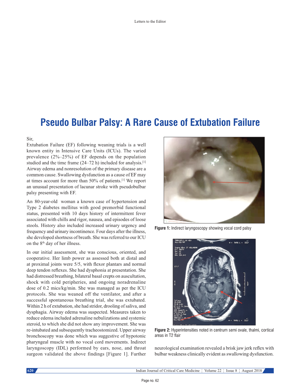 Pseudo Bulbar Palsy: a Rare Cause of Extubation Failure