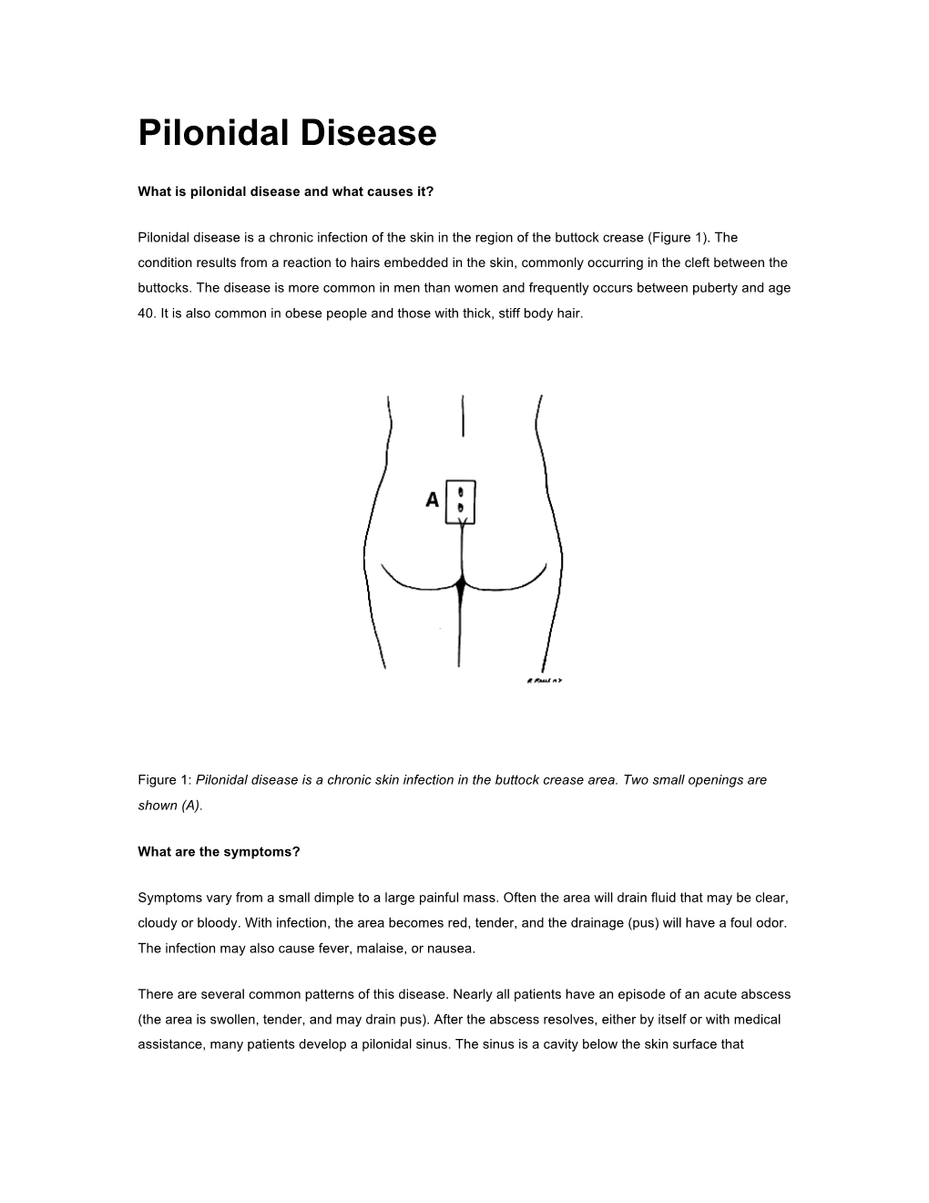 Pilonidal Disease