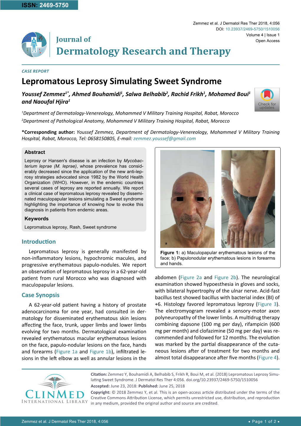 Lepromatous Leprosy Simulating Sweet Syndrome