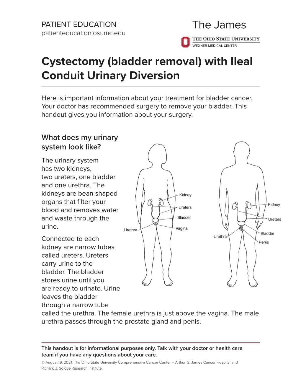 Cystectomy (Bladder Removal) with Ileal Conduit Urinary Diversion
