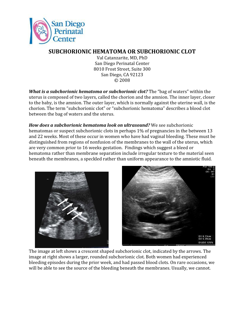 SUBCHORIONIC HEMATOMA OR SUBCHORIONIC CLOT Val Catanzarite, MD, Phd San Diego Perinatal Center 8010 Frost Street, Suite 300 San Diego, CA 92123 © 2008