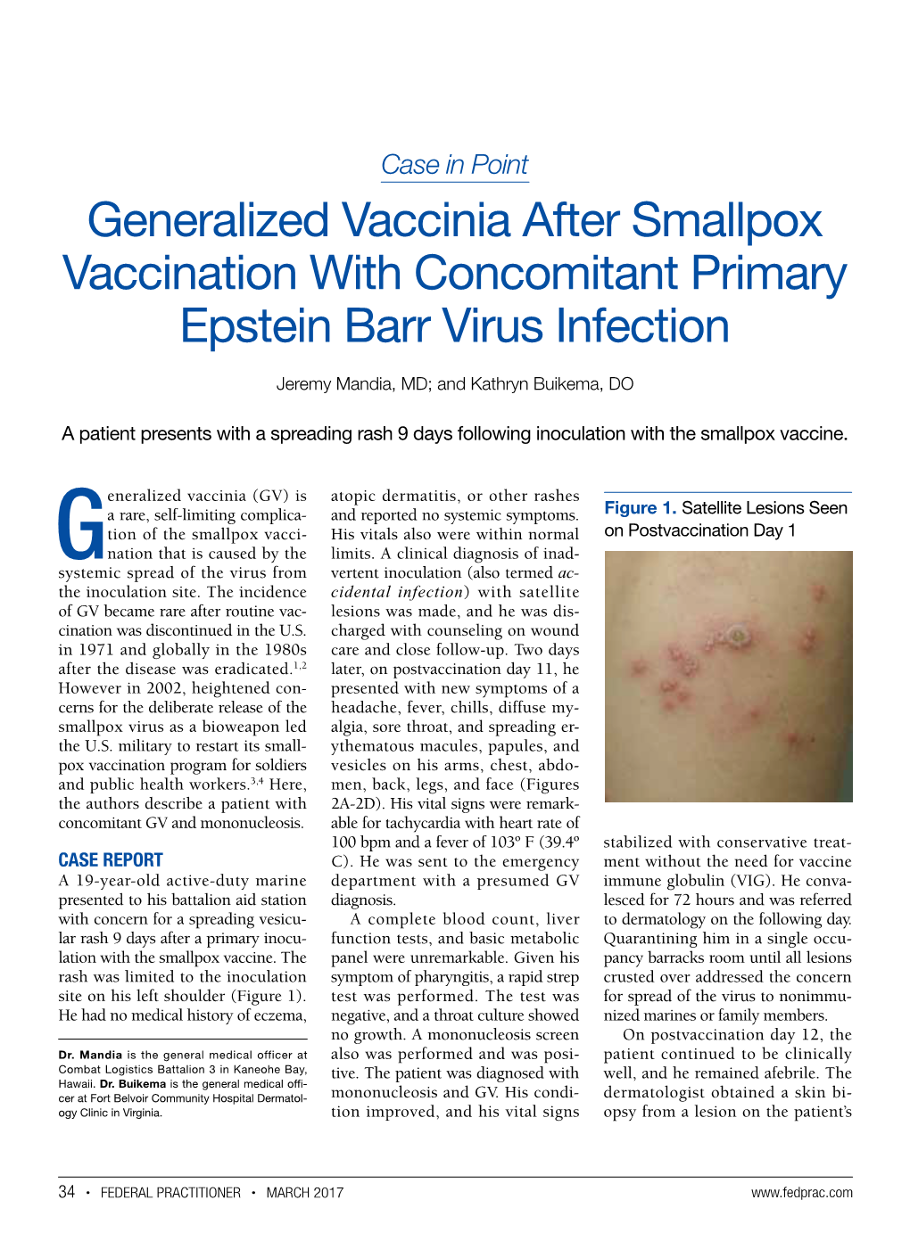 Generalized Vaccinia After Smallpox Vaccination with Concomitant Primary Epstein Barr Virus Infection