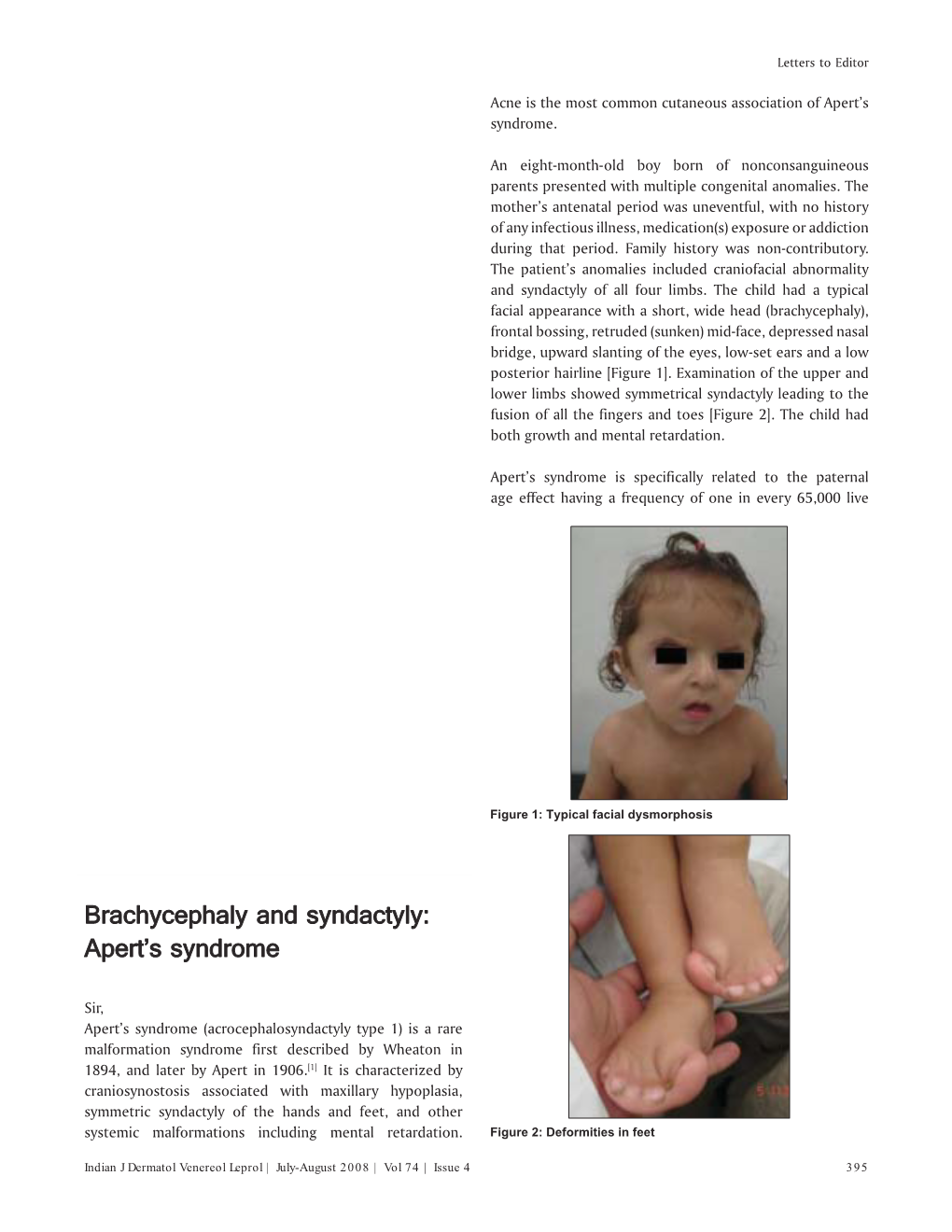 Brachycephaly and Syndactyly: Apert's Syndrome