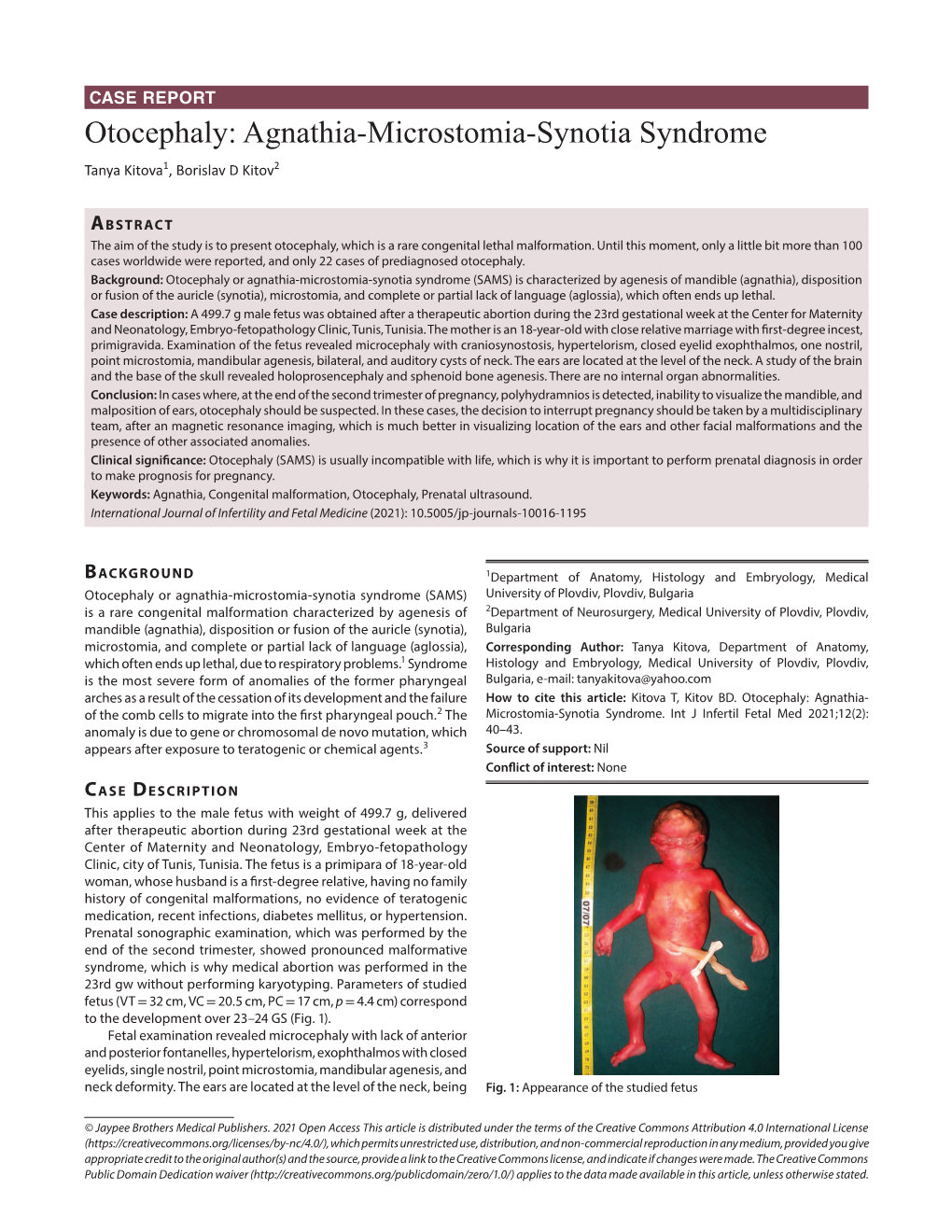 Otocephaly: Agnathia-Microstomia-Synotia Syndrome Tanya Kitova1, Borislav D Kitov2