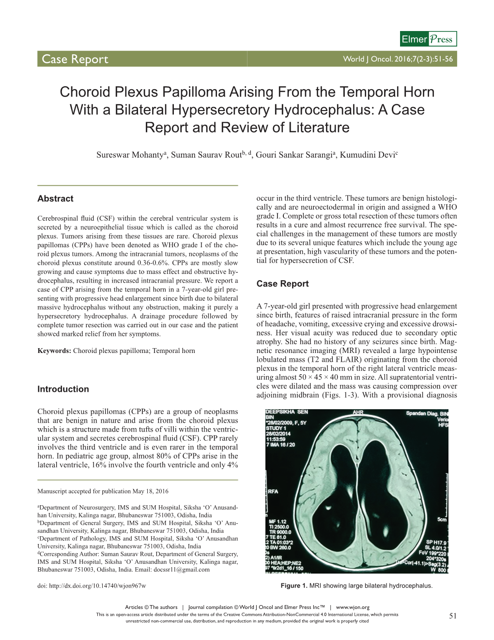 Choroid Plexus Papilloma Arising from the Temporal Horn with a Bilateral Hypersecretory Hydrocephalus: a Case Report and Review of Literature