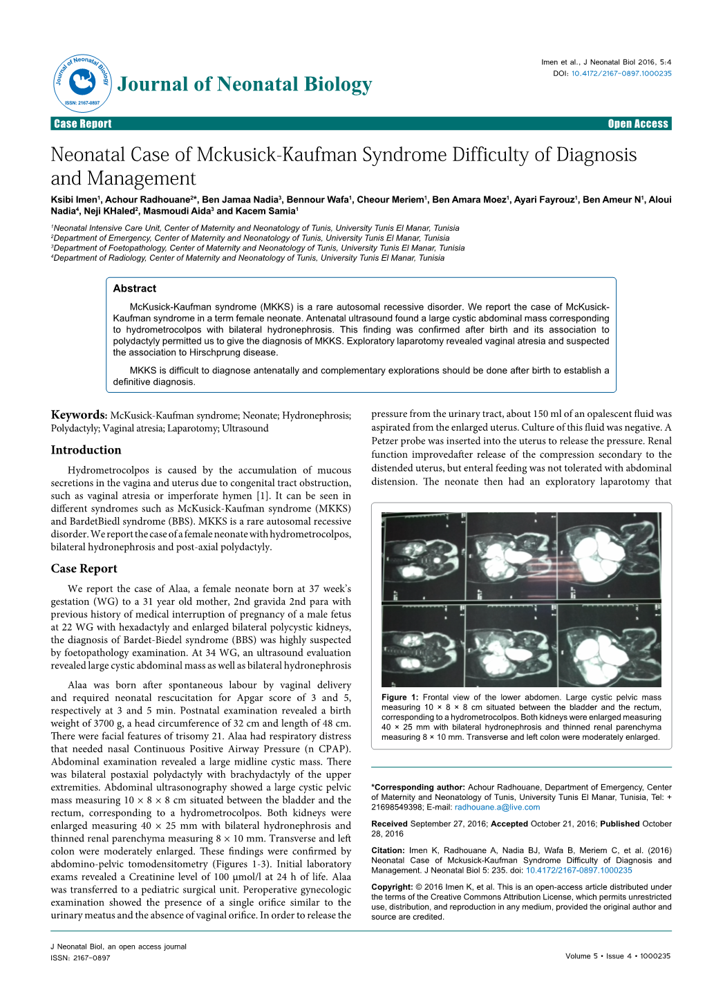 Neonatal Case of Mckusick-Kaufman Syndrome Difficulty of Diagnosis