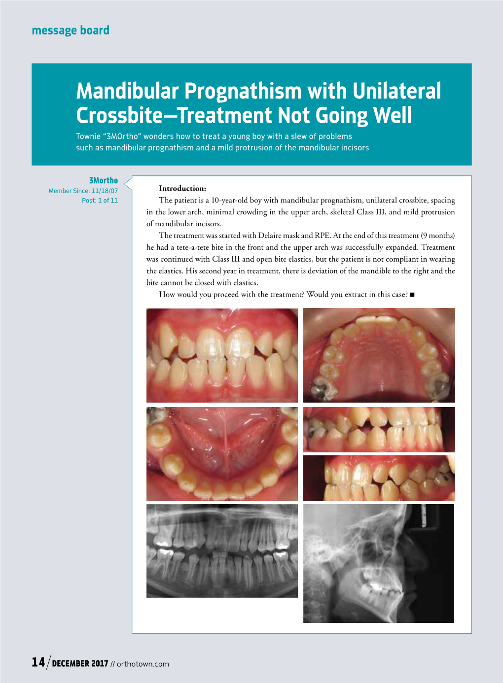 Mandibular Prognathism with Unilateral Crossbite—Treatment