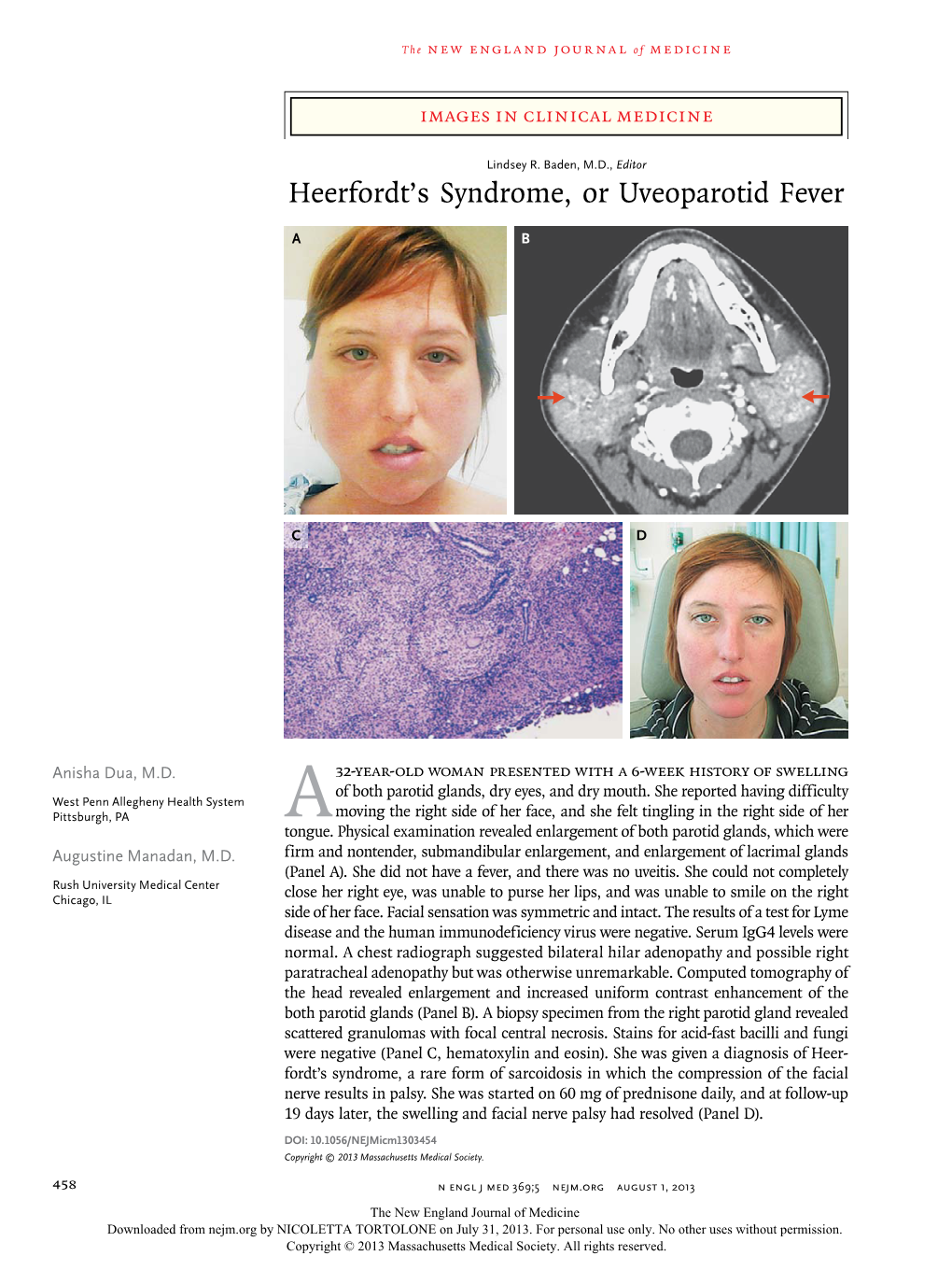 Heerfordt's Syndrome, Or Uveoparotid Fever