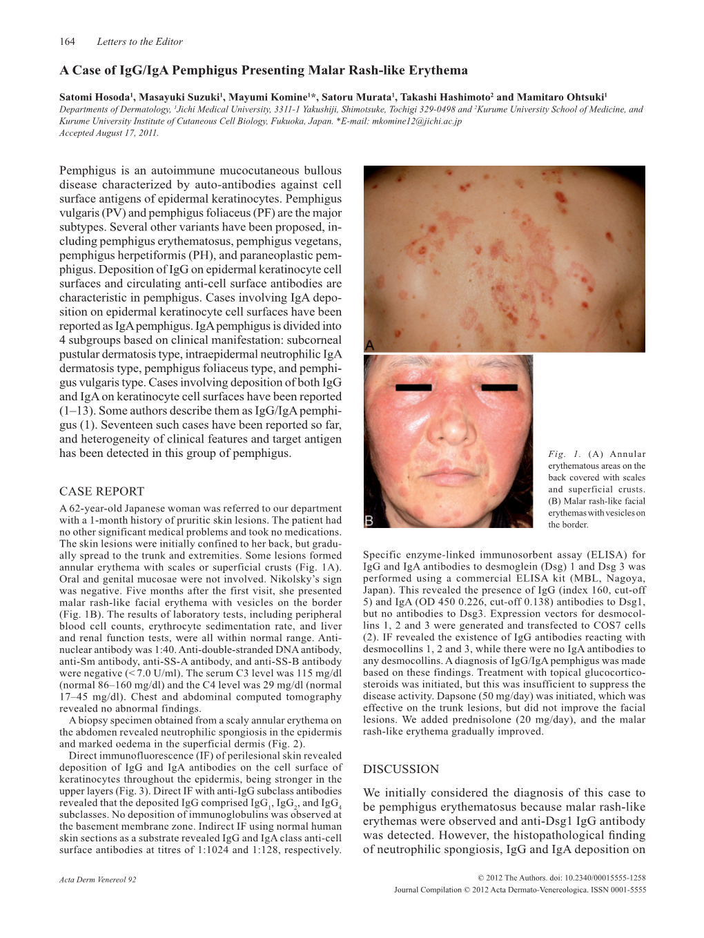 A Case of Igg/Iga Pemphigus Presenting Malar Rash-Like Erythema