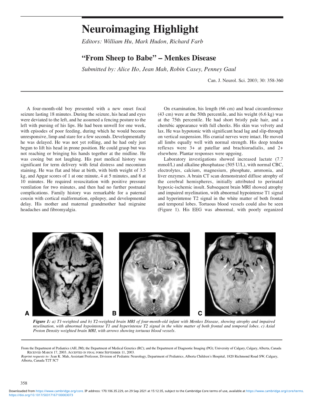 Menkes Disease Submitted By: Alice Ho, Jean Mah, Robin Casey, Penney Gaul