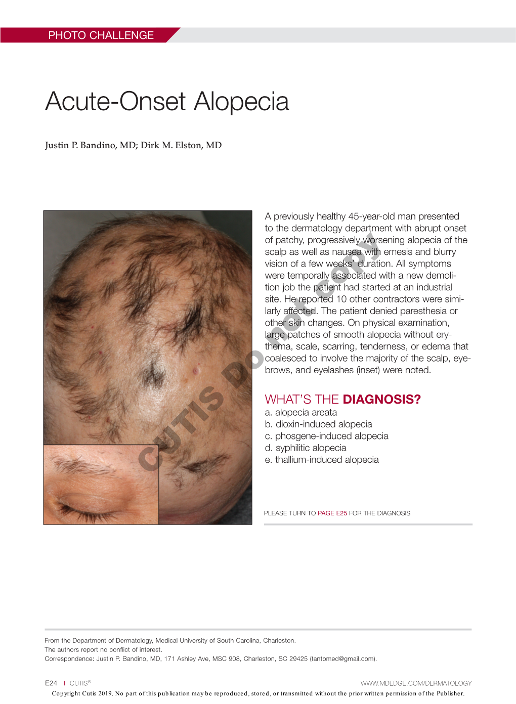 Acute-Onset Alopecia