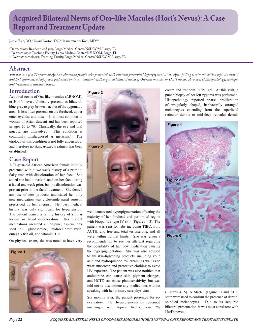 Acquired Bilateral Nevus of Ota–Like Macules (Hori's Nevus): a Case