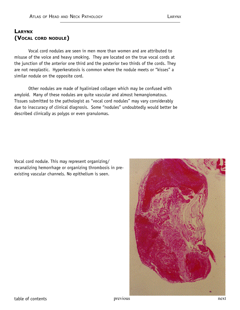 Larynx (Vocal Cord Nodule)