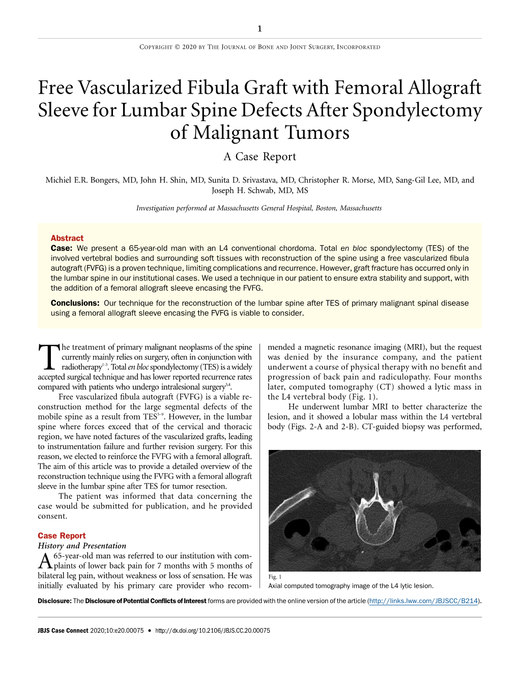 Free Vascularized Fibula Graft with Femoral Allograft Sleeve for Lumbar Spine Defects After Spondylectomy of Malignant Tumors Acasereport