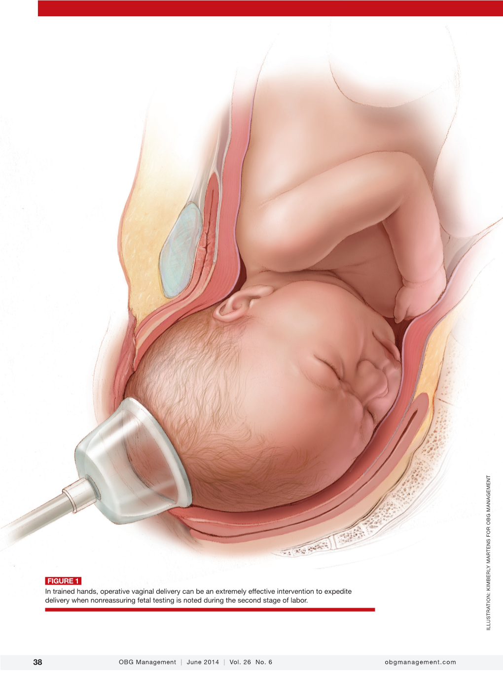 FIGURE 1 in Trained Hands, Operative Vaginal Delivery Can Be An