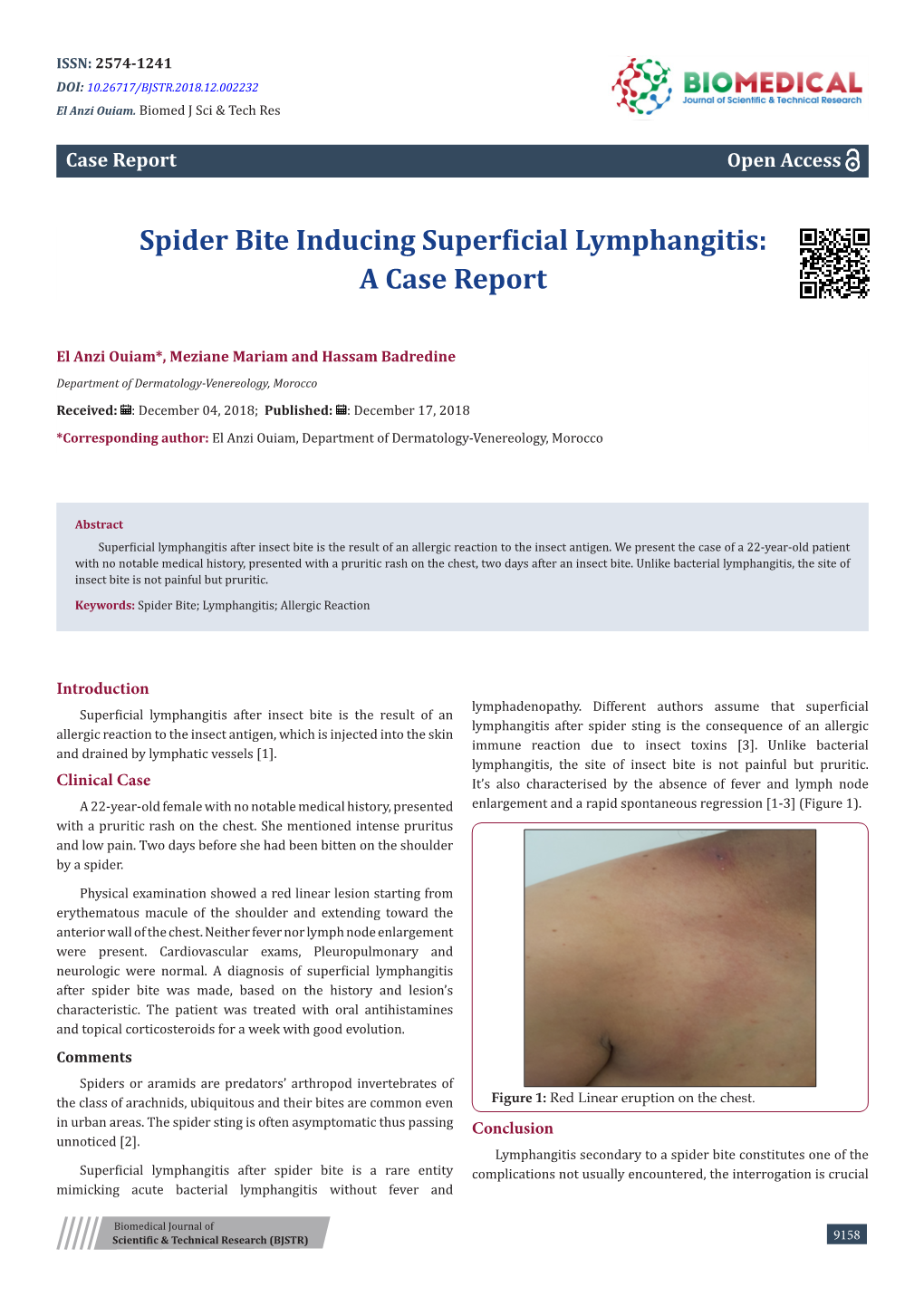 Spider Bite Inducing Superficial Lymphangitis: a Case Report