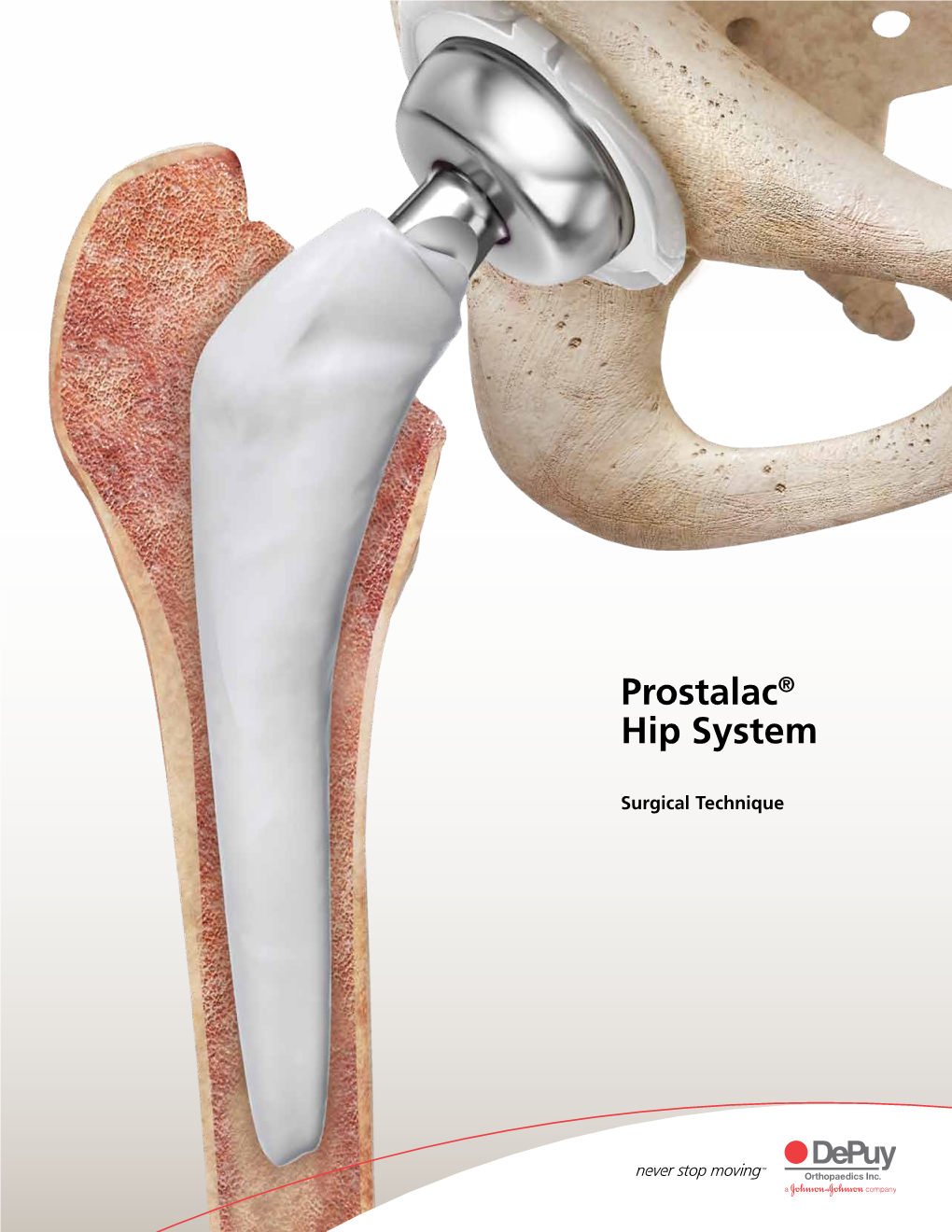Prostalac® Hip System
