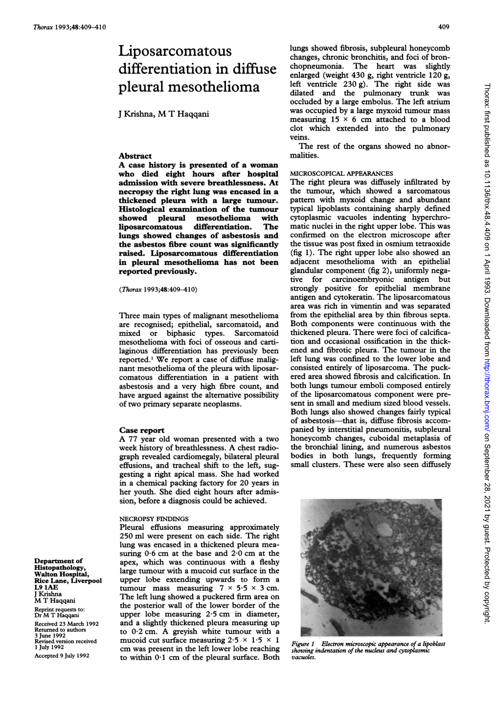 Pleural Mesothelioma Dilated and the Pulmonary Trunk Was Occluded by a Large Embolus