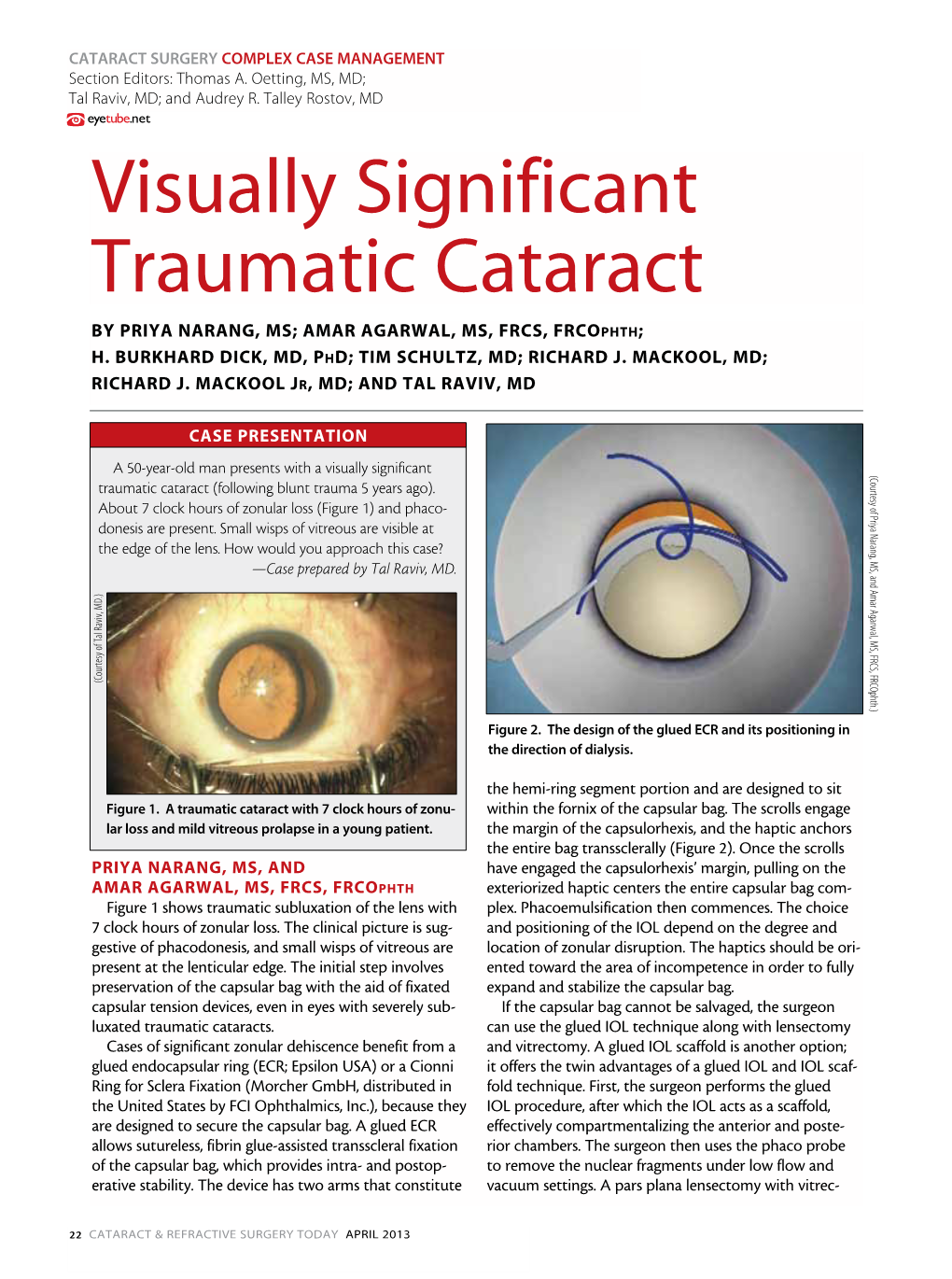 Visually Significant Traumatic Cataract