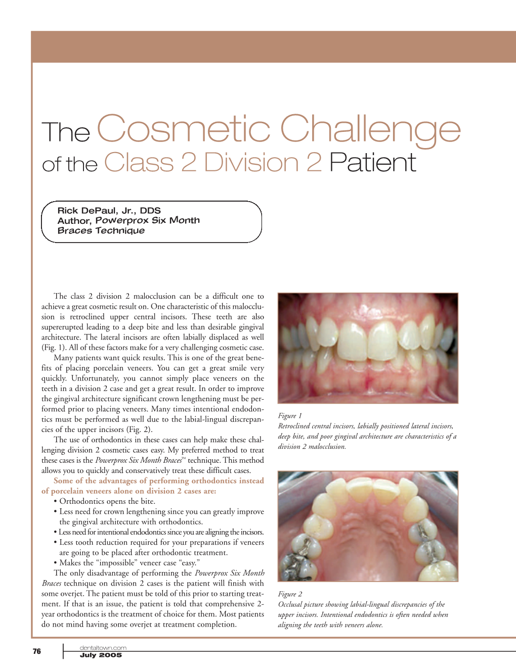 The Cosmetic Challenge of the Class 2 Division 2 Patient