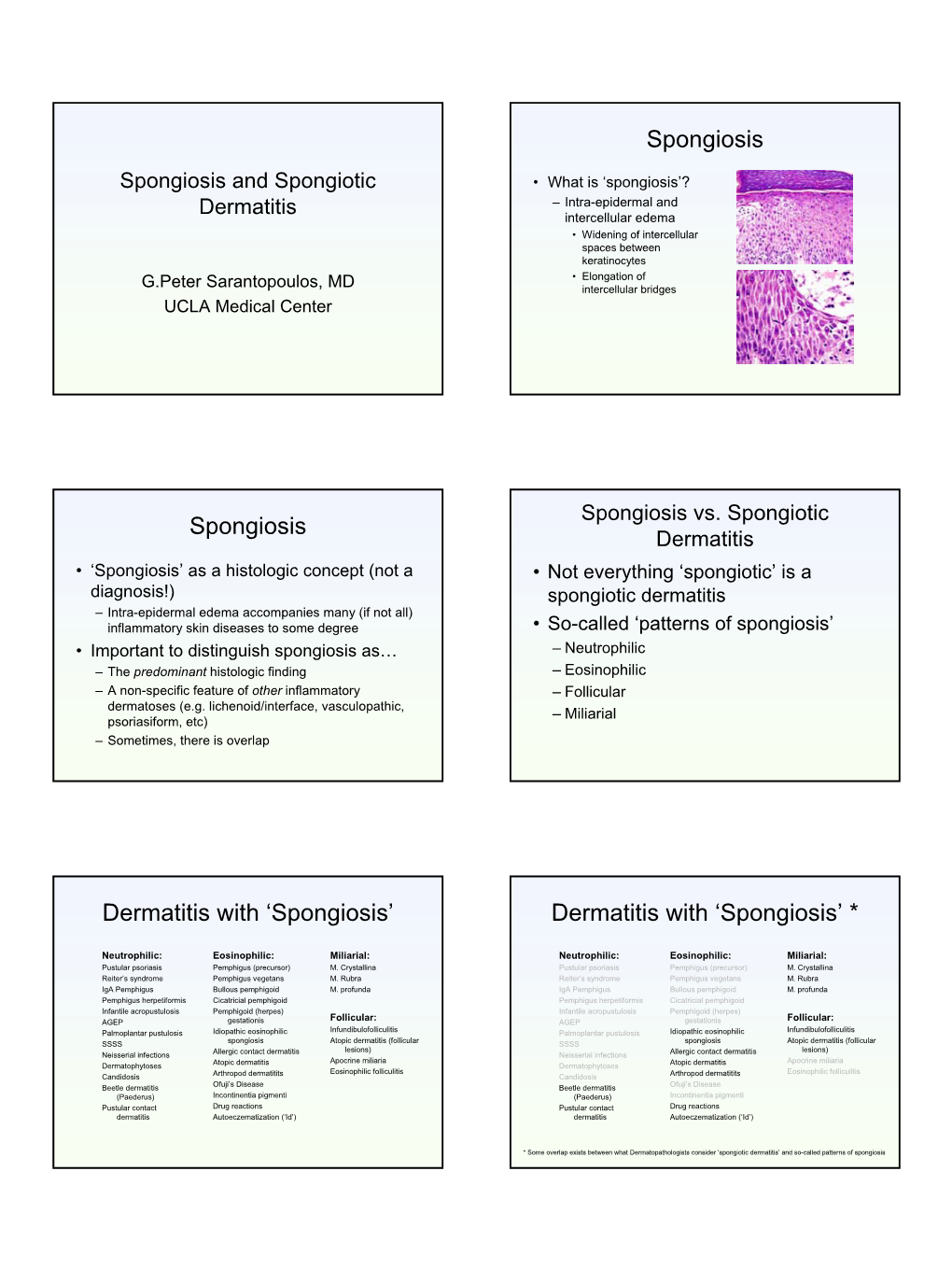 'Spongiosis' Dermatitis With