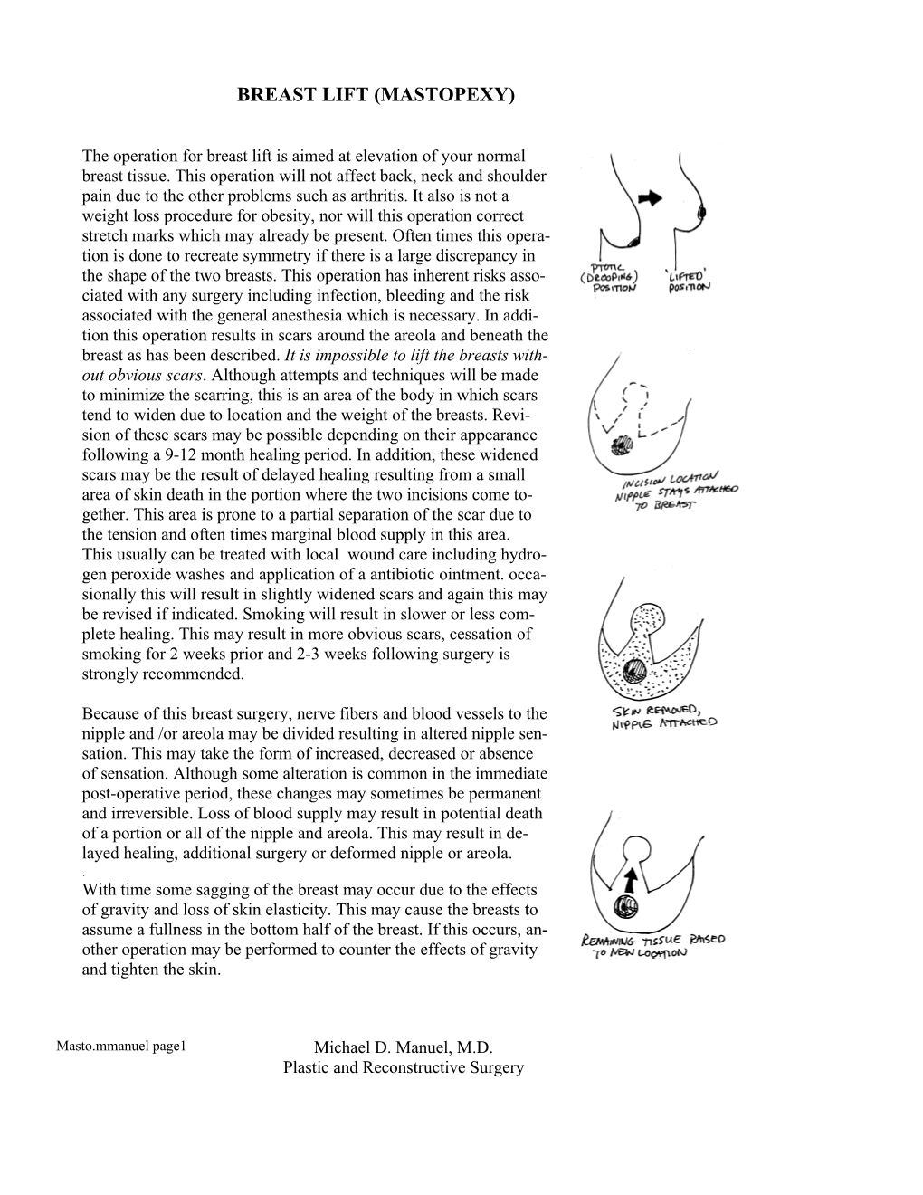 Breast Lift (Mastopexy)