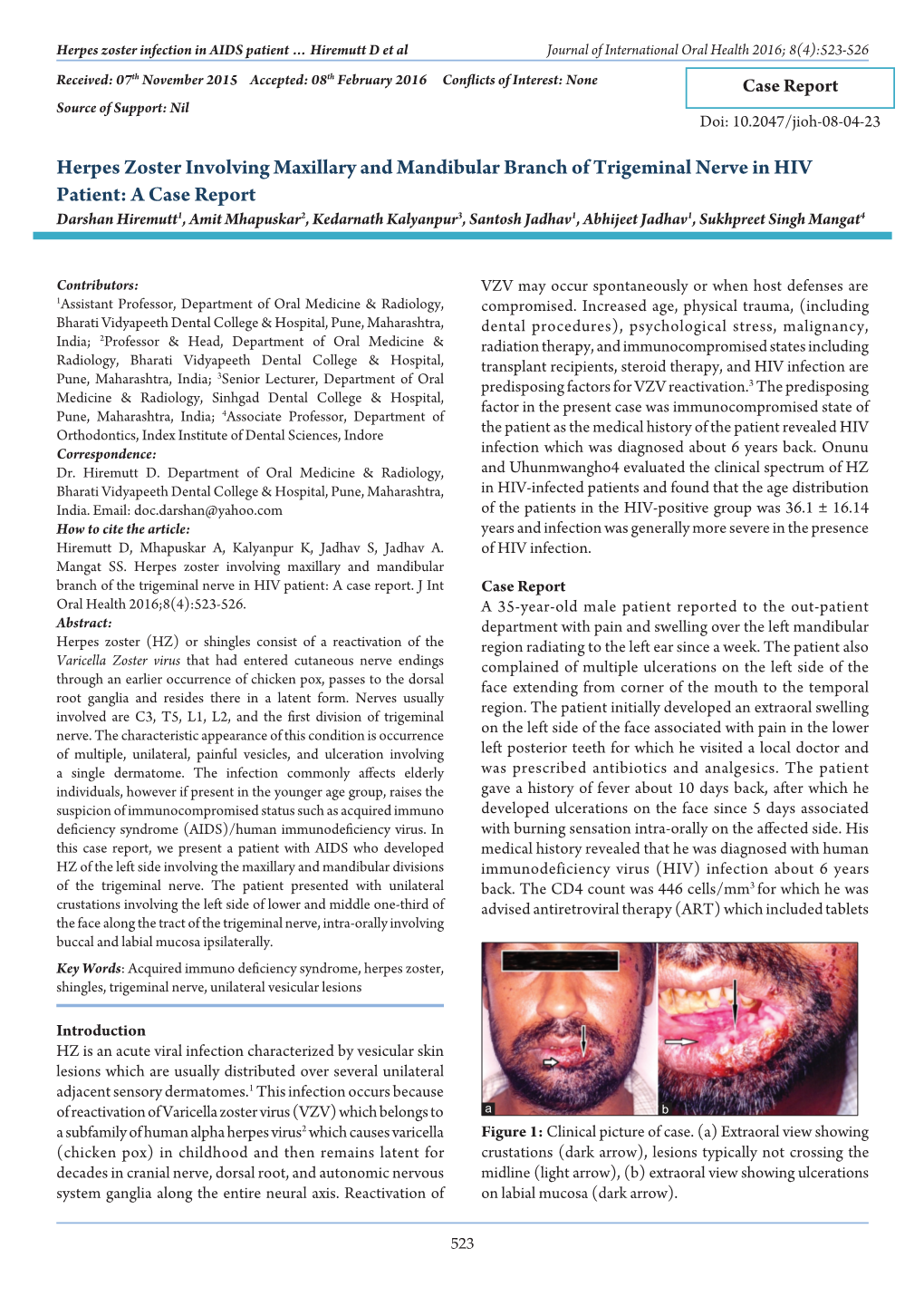 Herpes Zoster Involving Maxillary and Mandibular Branch of Trigeminal