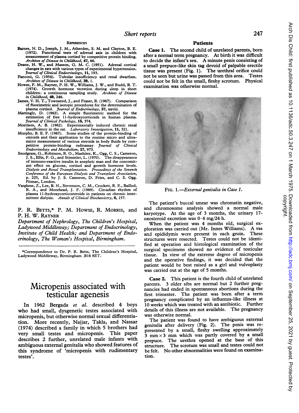 Micropenis Associated with Testicular Agenesis