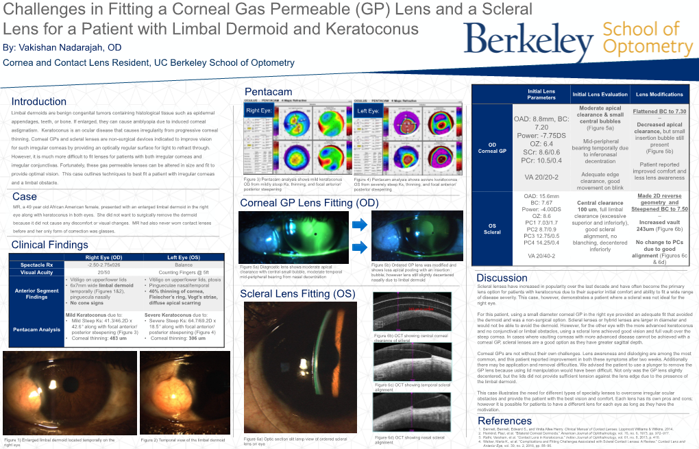 Lens for a Patient with Limbal Dermoid and Keratoconus