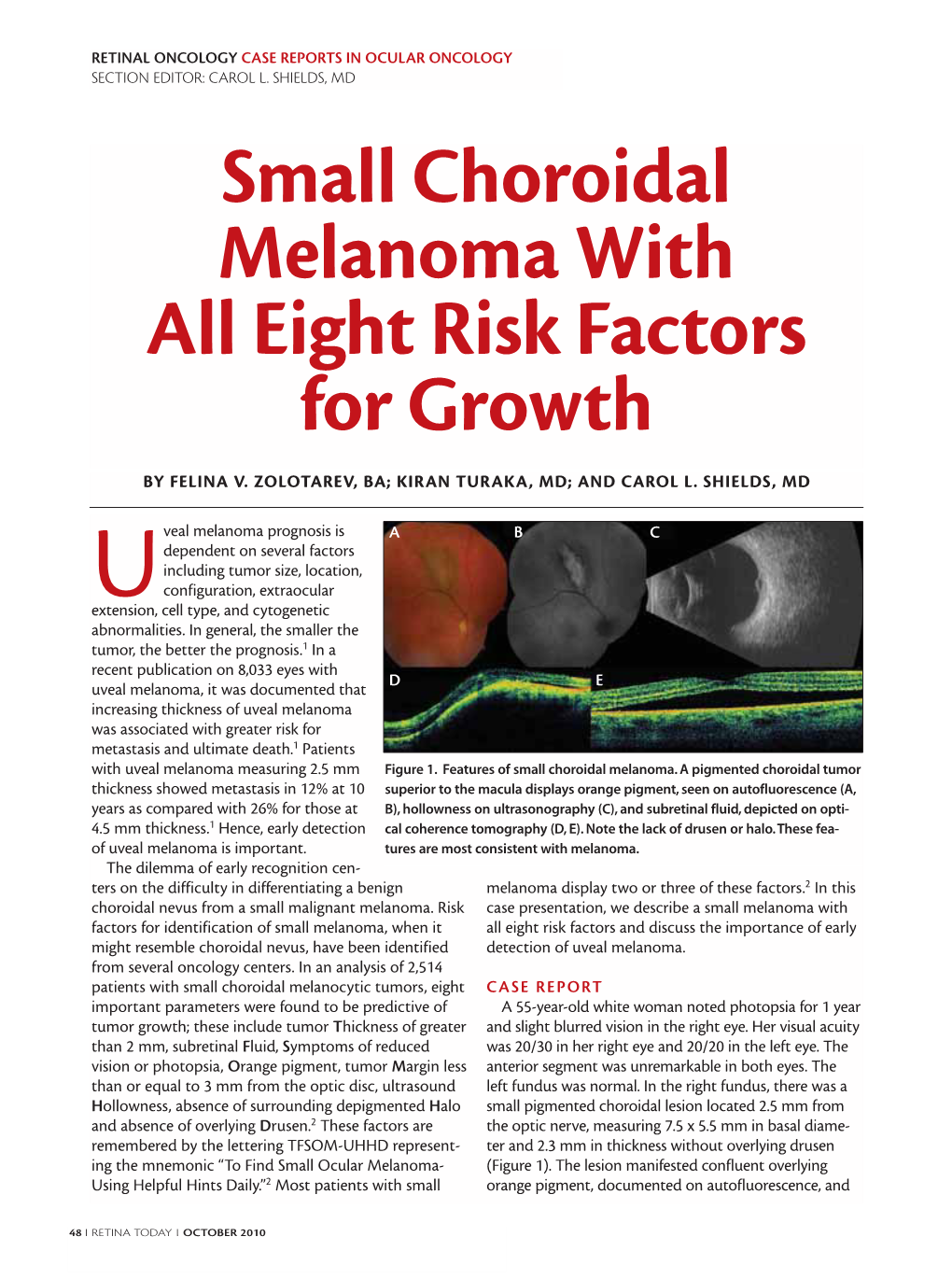 Small Choroidal Melanoma with All Eight Risk Factors for Growth